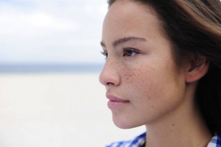 Fleke na koži – kako ukloniti hiperpigmentacije
